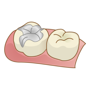 金合金（保険適用の銀歯）