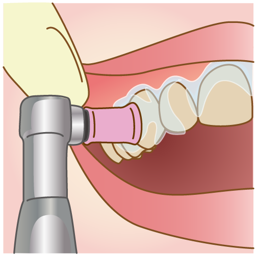 P.M.T.C.（プロの手による歯のクリーニング）