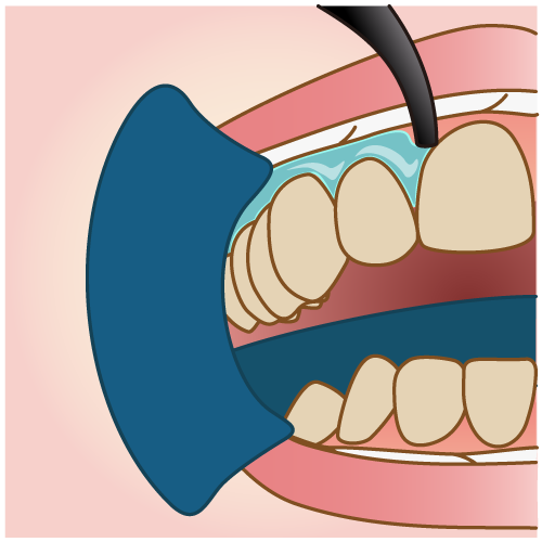 歯茎を保護する薬剤を塗布